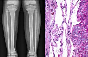 sarcoma2